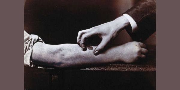 An antique black and white photograph showing a hand held over a dark mark on a forearm demonstrating the manual treatment of ulcers